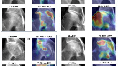 Detecting hip osteoarthritis on clinical CT: A deep learning application based on 2-D summation images derived from CT featured image