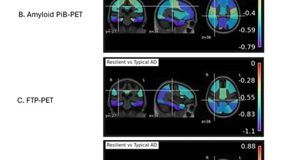 Precise Estimation Of Heterogenous Global Tau Burden In The Brain Sheds Light On Cognitive Resilience Mechanisms featured image