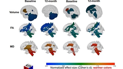 Precise disease heterogeneity and progression quantification in MSA and Parkinson's disease using machine learning featured image